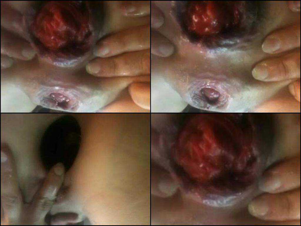 Incredible homemade very closeup huge prolapse anal penetrate