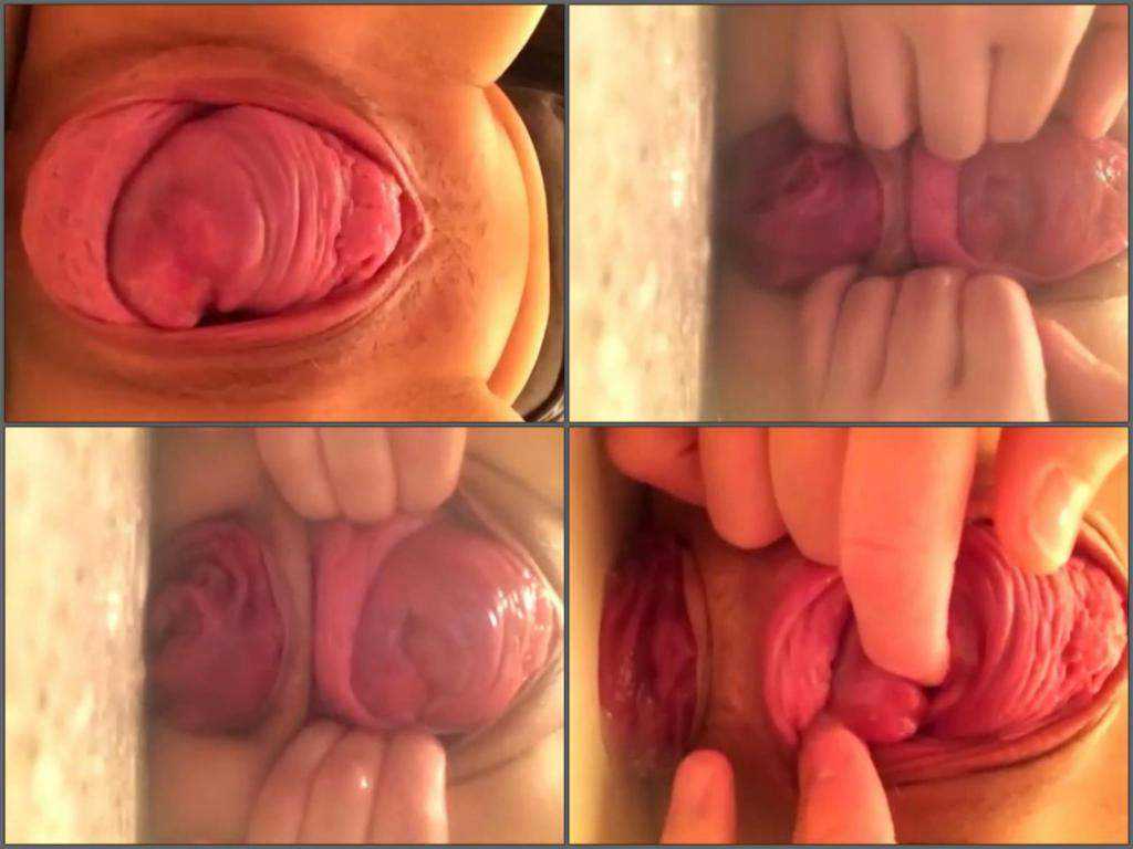 Porn cervix prolapse Free Cervix