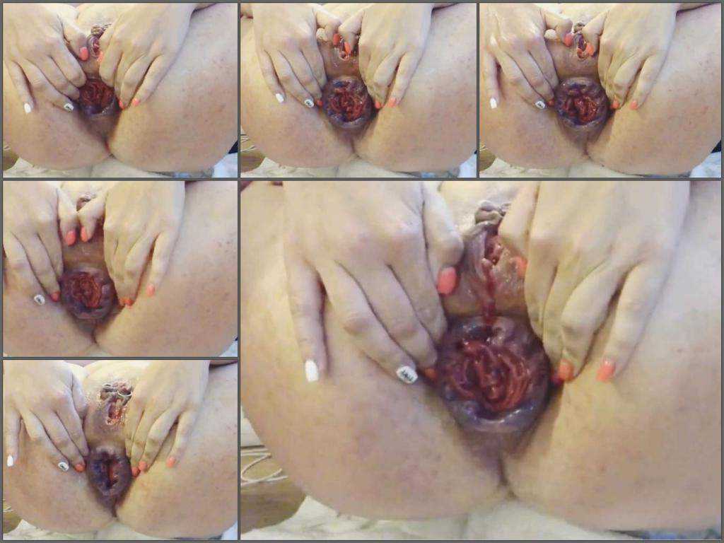 Bloody anal – Bloody anal prolapse with large labia MILF
